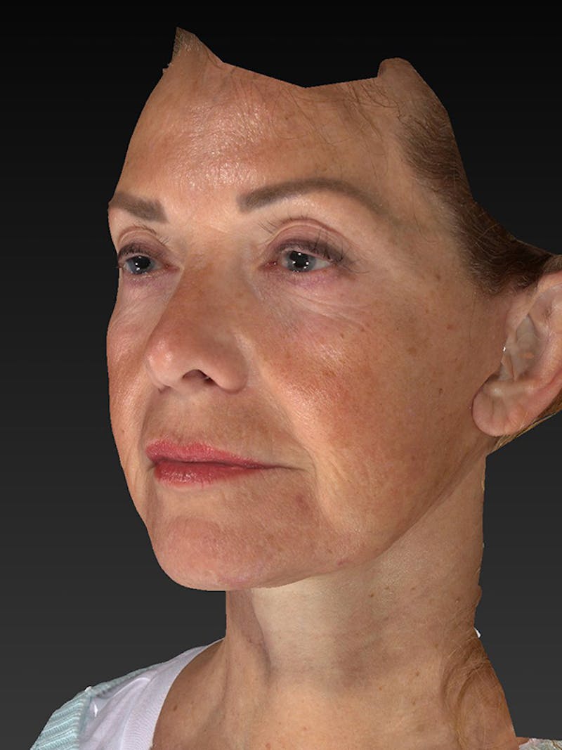 Lower Face & Neck Lift Before & After Gallery - Patient 191429 - Image 8