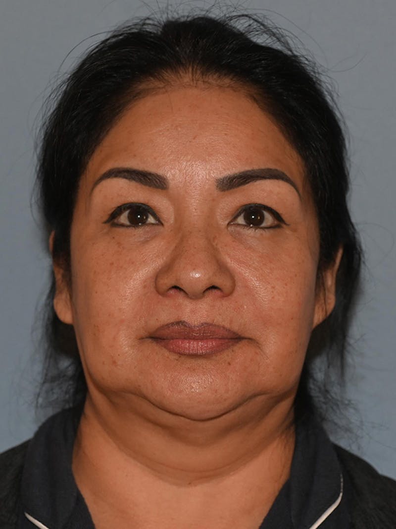 Lower Face & Neck Lift Before & After Gallery - Patient 393983 - Image 1