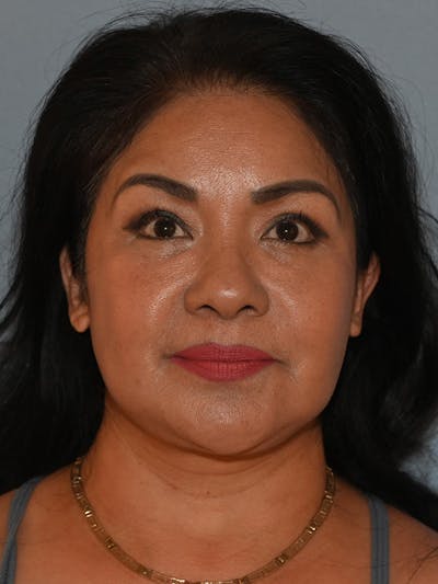 Lower Face & Neck Lift Before & After Gallery - Patient 393983 - Image 2