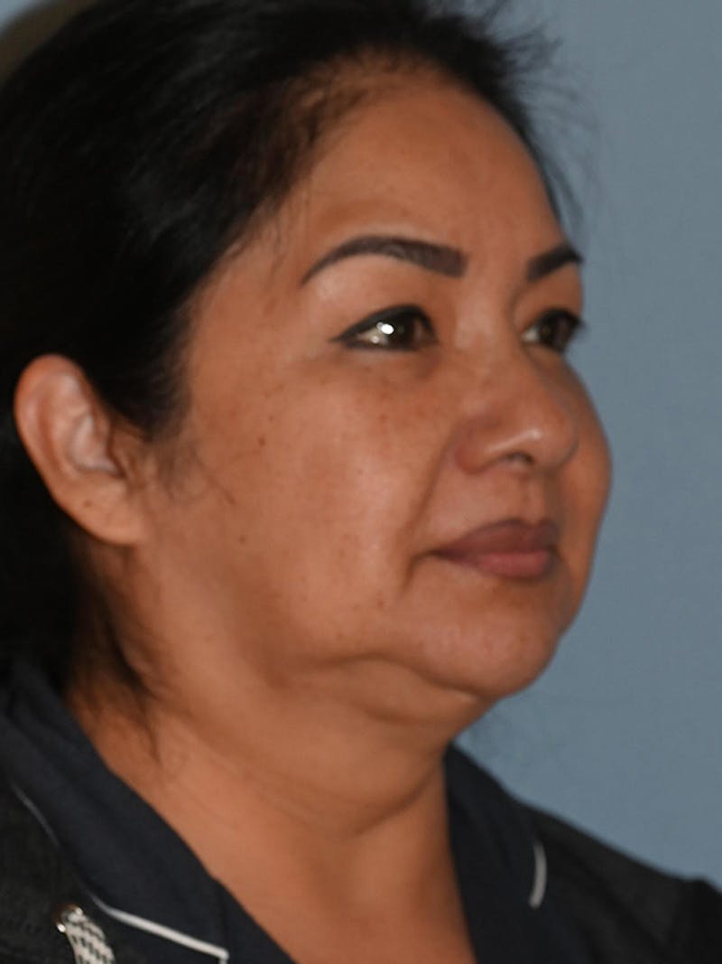 Lower Face & Neck Lift Before & After Gallery - Patient 393983 - Image 3