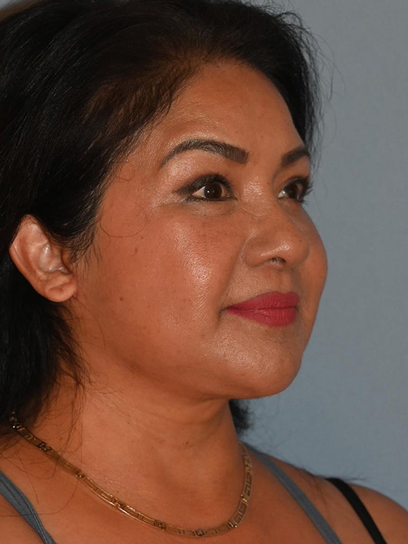 Lower Face & Neck Lift Before & After Gallery - Patient 393983 - Image 4
