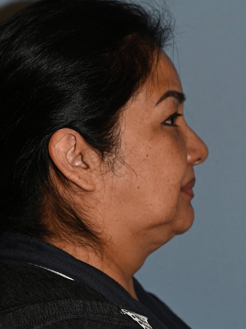 Lower Face & Neck Lift Before & After Gallery - Patient 393983 - Image 5