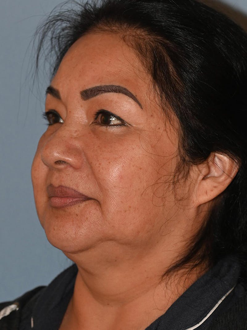 Lower Face & Neck Lift Before & After Gallery - Patient 393983 - Image 7