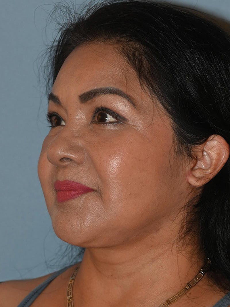 Lower Face & Neck Lift Before & After Gallery - Patient 393983 - Image 8