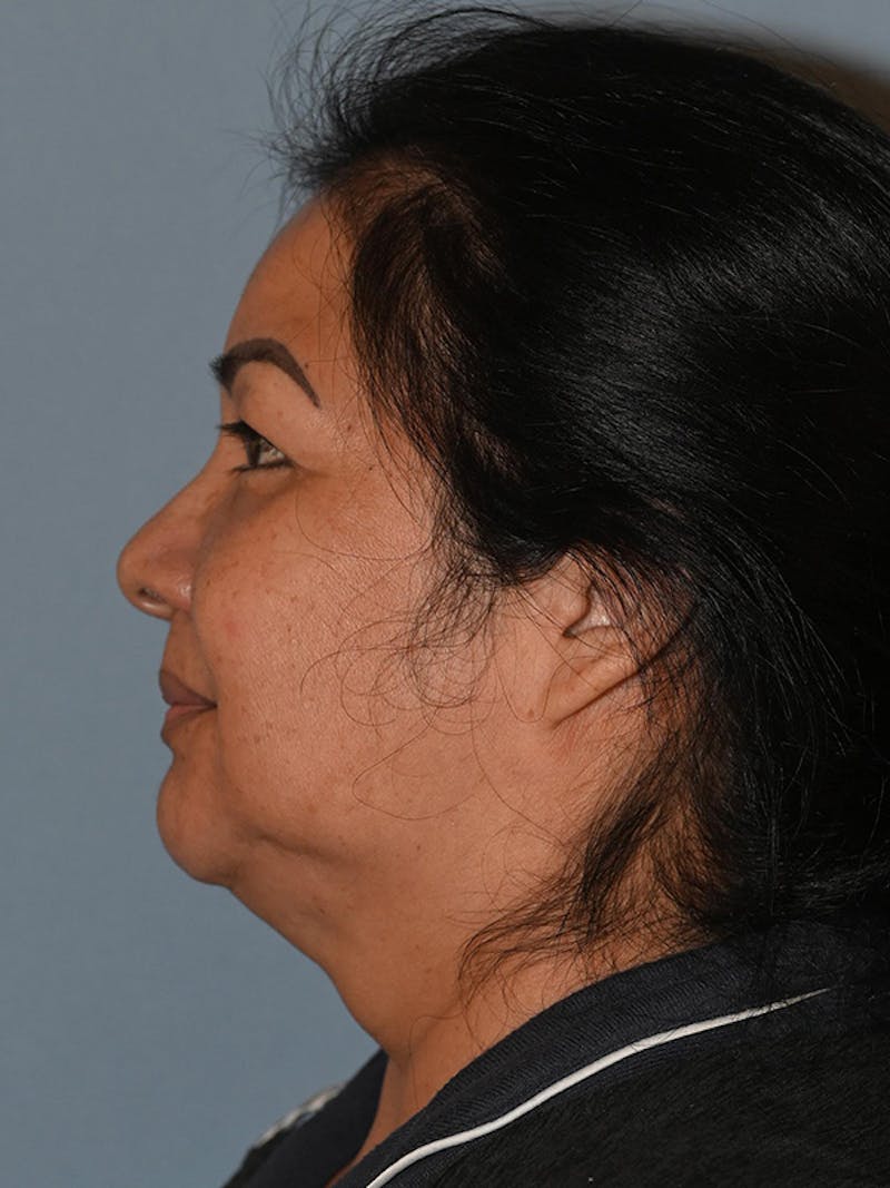 Lower Face & Neck Lift Before & After Gallery - Patient 393983 - Image 9