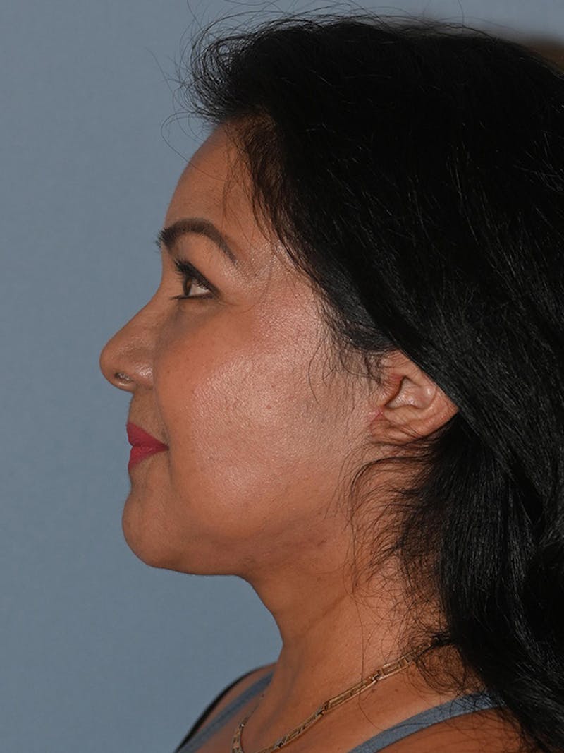 Lower Face & Neck Lift Before & After Gallery - Patient 393983 - Image 10