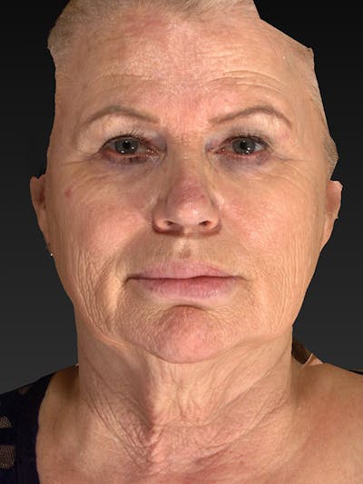 Lower Face & Neck Lift Before & After Gallery - Patient 325379 - Image 1