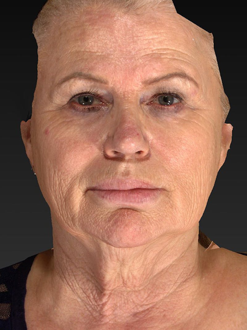 Lower Face & Neck Lift Before & After Gallery - Patient 325379 - Image 1