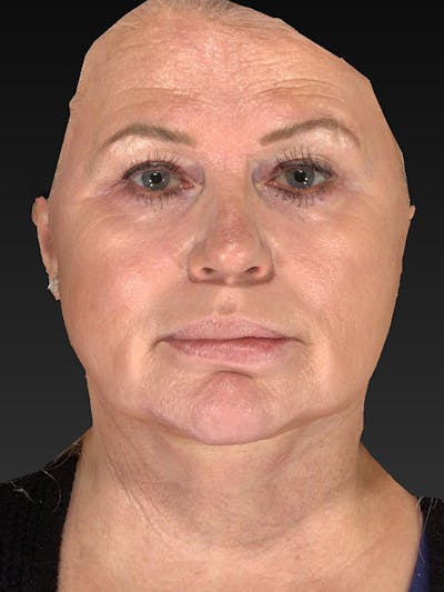 Lower Face & Neck Lift Before & After Gallery - Patient 325379 - Image 2