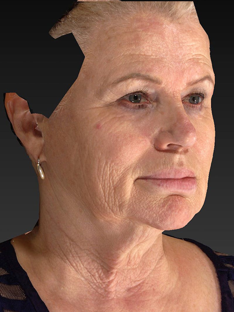 Lower Face & Neck Lift Before & After Gallery - Patient 325379 - Image 3