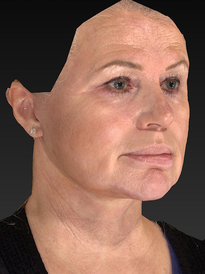 Lower Face & Neck Lift Before & After Gallery - Patient 325379 - Image 4
