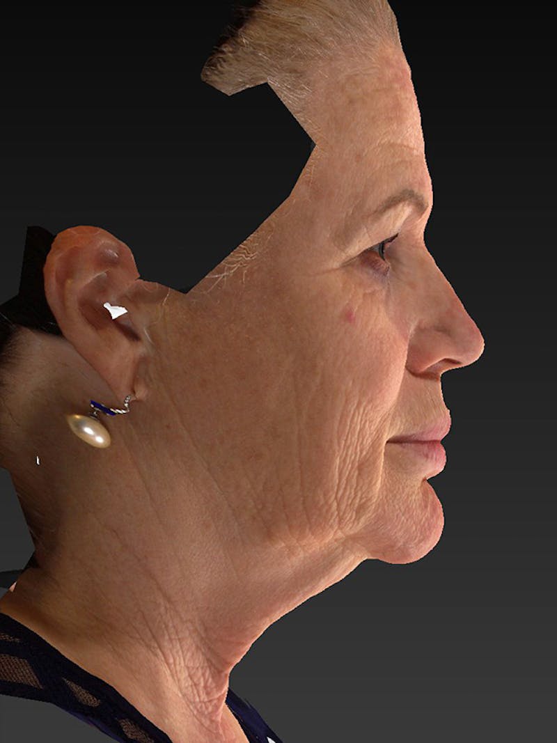 Lower Face & Neck Lift Before & After Gallery - Patient 325379 - Image 5