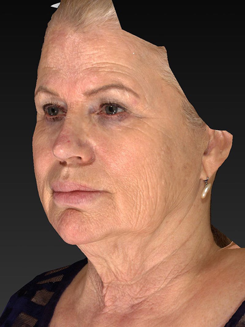 Lower Face & Neck Lift Before & After Gallery - Patient 325379 - Image 7