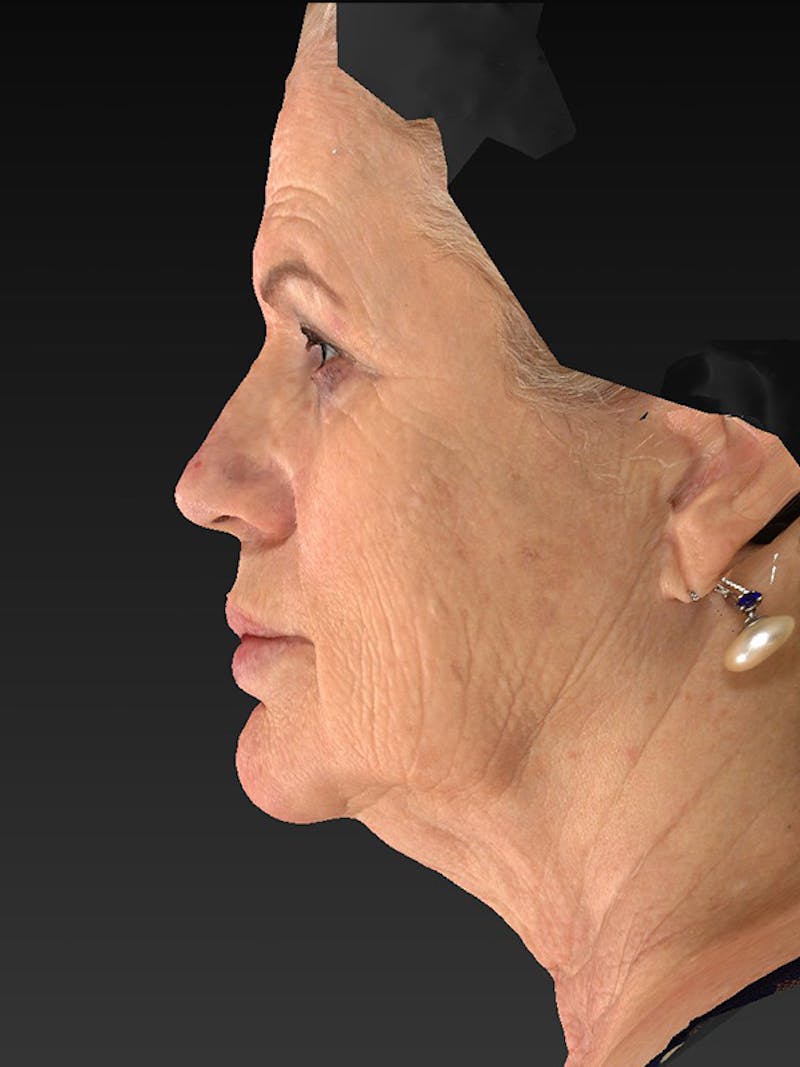 Lower Face & Neck Lift Before & After Gallery - Patient 325379 - Image 9