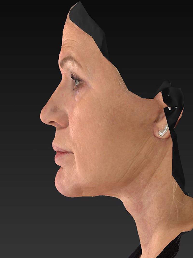 Lower Face & Neck Lift Before & After Gallery - Patient 325379 - Image 10