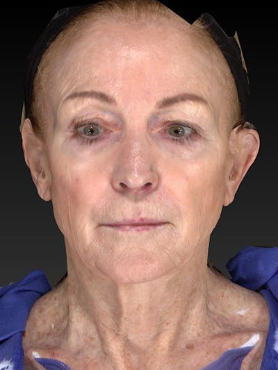 Lower Face & Neck Lift Before & After Gallery - Patient 455157 - Image 1