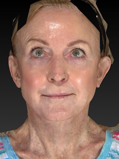 Lower Face & Neck Lift Before & After Gallery - Patient 455157 - Image 2