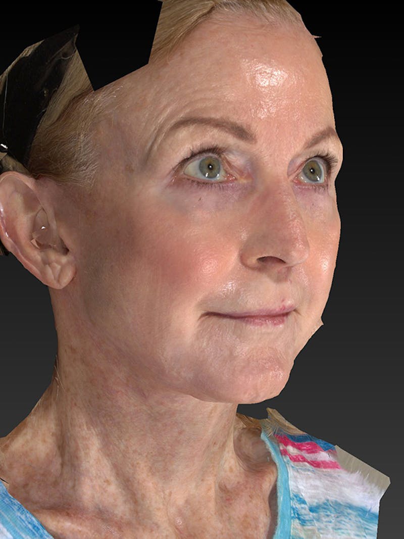 Lower Face & Neck Lift Before & After Gallery - Patient 455157 - Image 4