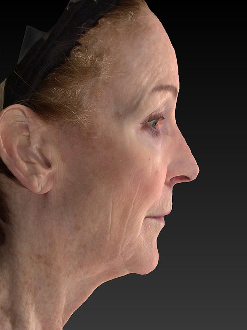 Lower Face & Neck Lift Before & After Gallery - Patient 455157 - Image 5