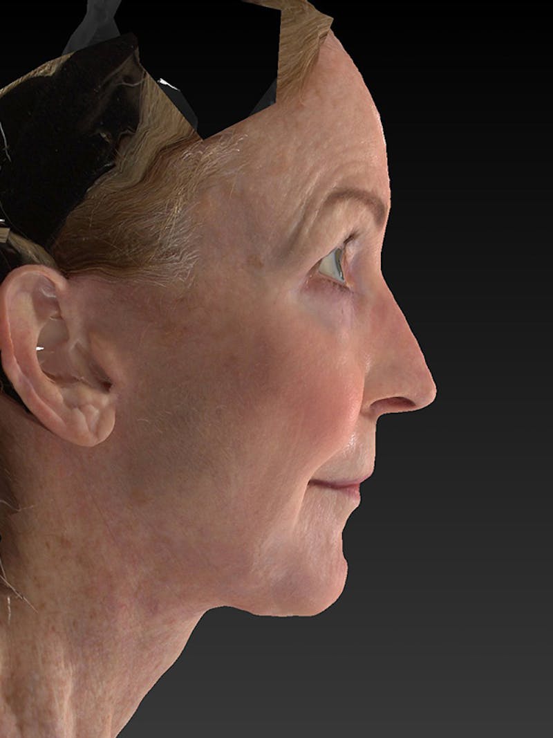 Lower Face & Neck Lift Before & After Gallery - Patient 455157 - Image 6
