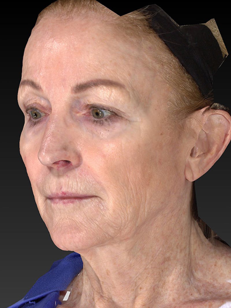 Lower Face & Neck Lift Before & After Gallery - Patient 455157 - Image 7