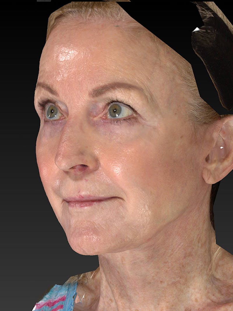 Lower Face & Neck Lift Before & After Gallery - Patient 455157 - Image 8