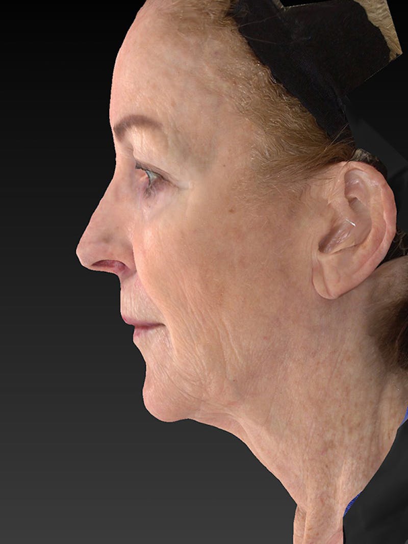 Lower Face & Neck Lift Before & After Gallery - Patient 455157 - Image 9