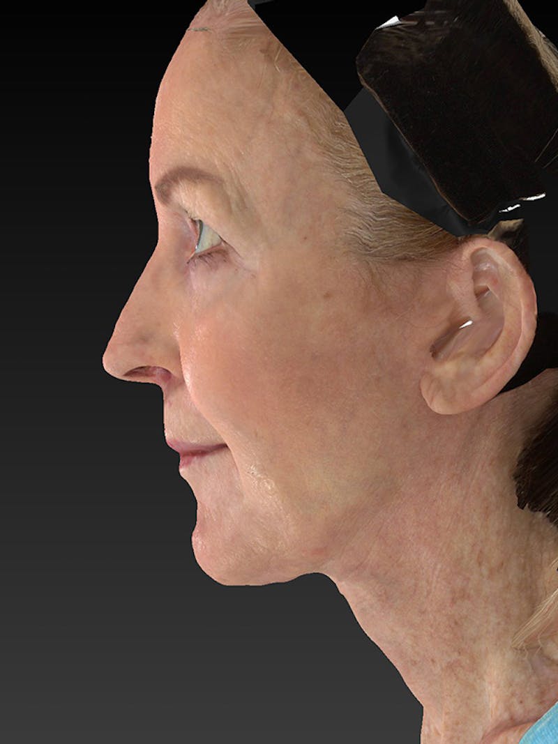Lower Face & Neck Lift Before & After Gallery - Patient 455157 - Image 10