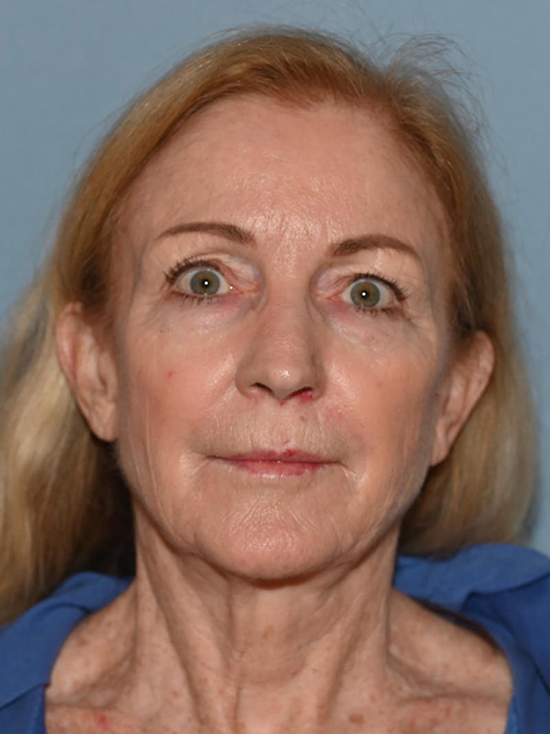 Lower Face & Neck Lift Before & After Gallery - Patient 455157 - Image 11
