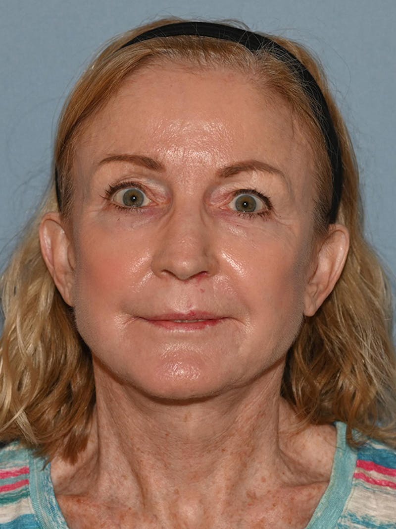 Lower Face & Neck Lift Before & After Gallery - Patient 455157 - Image 12