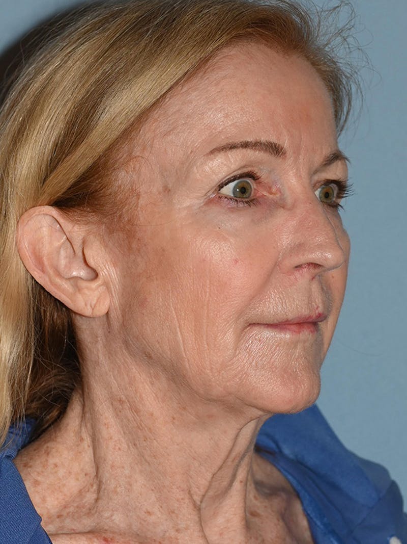 Lower Face & Neck Lift Before & After Gallery - Patient 455157 - Image 13