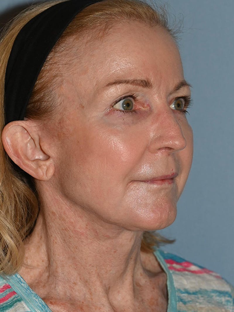 Lower Face & Neck Lift Before & After Gallery - Patient 455157 - Image 14