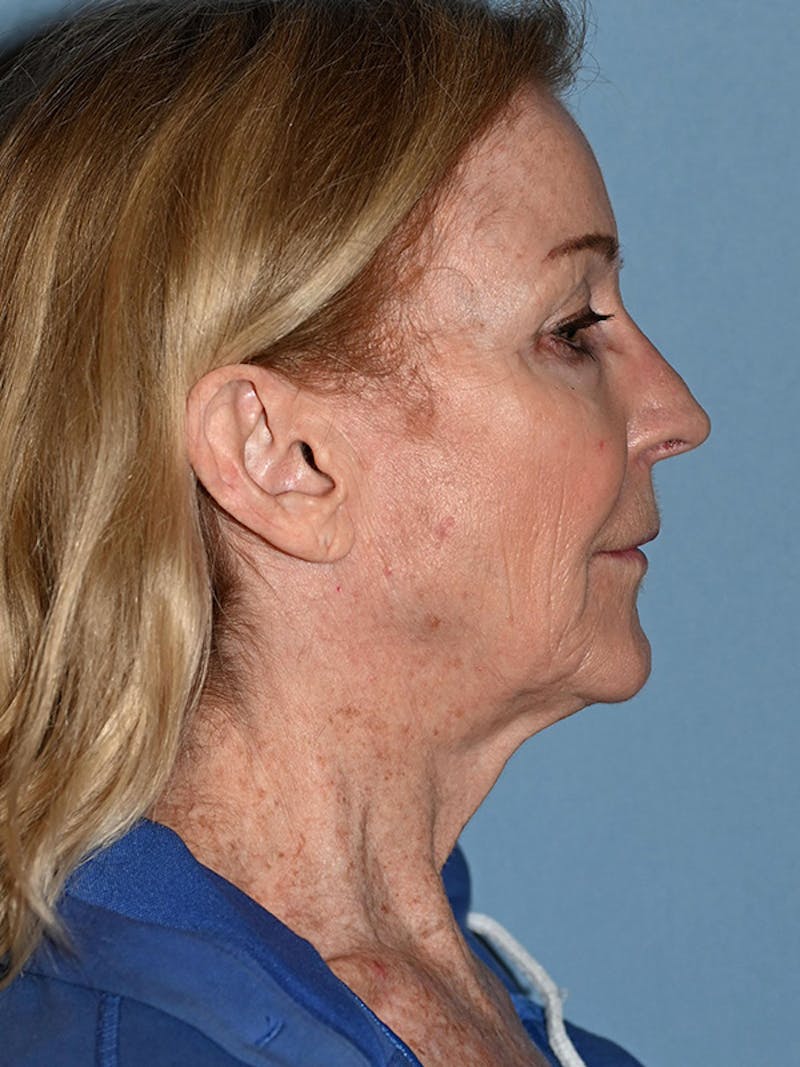 Lower Face & Neck Lift Before & After Gallery - Patient 455157 - Image 15