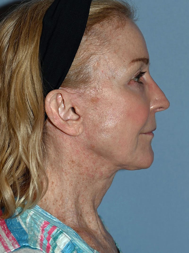 Lower Face & Neck Lift Before & After Gallery - Patient 455157 - Image 16
