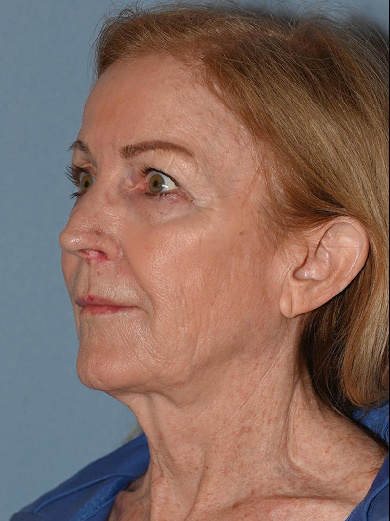 Lower Face & Neck Lift Before & After Gallery - Patient 455157 - Image 17
