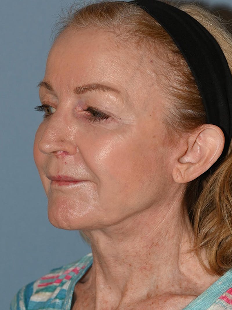 Lower Face & Neck Lift Before & After Gallery - Patient 455157 - Image 18