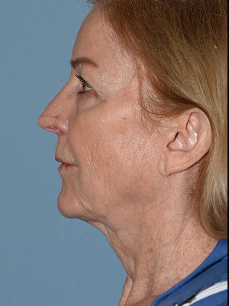 Lower Face & Neck Lift Before & After Gallery - Patient 455157 - Image 19