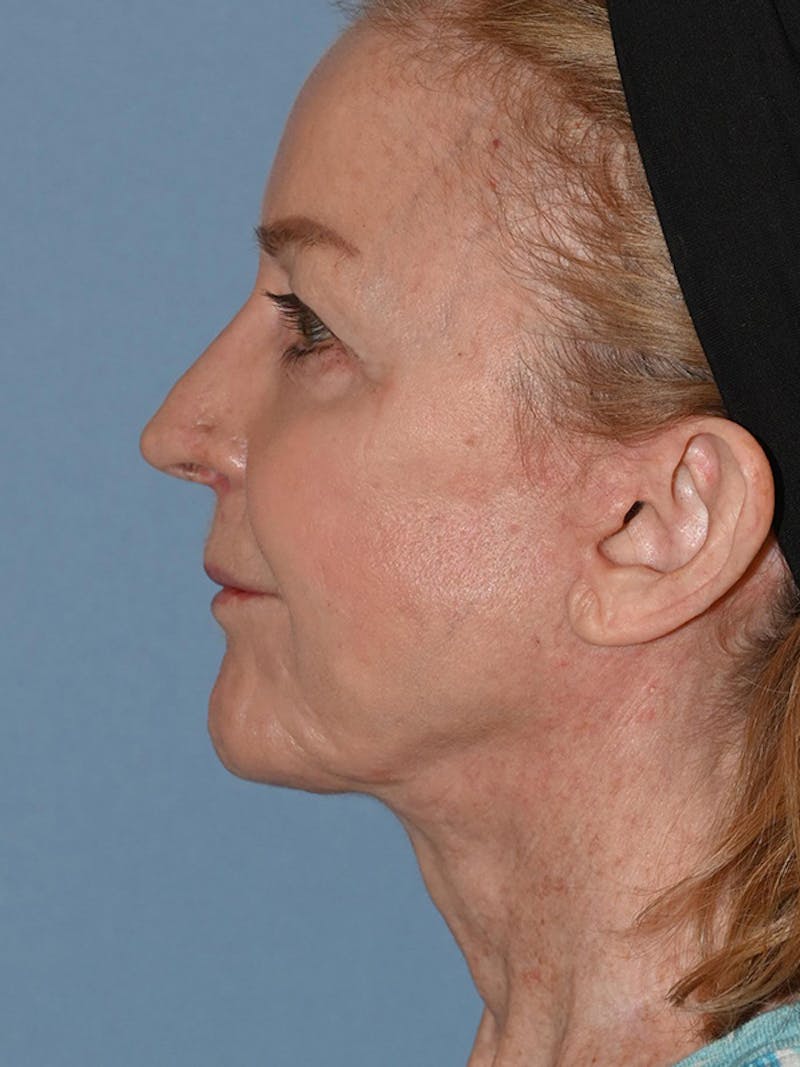 Lower Face & Neck Lift Before & After Gallery - Patient 455157 - Image 20