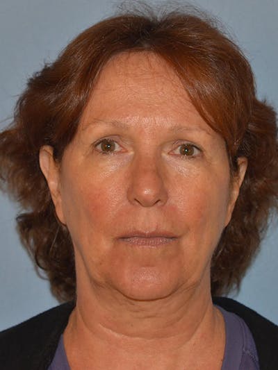 Lower Face & Neck Lift Before & After Gallery - Patient 277834 - Image 1
