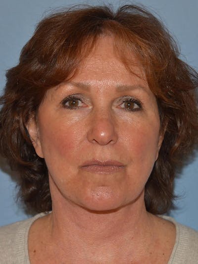 Lower Face & Neck Lift Before & After Gallery - Patient 277834 - Image 2
