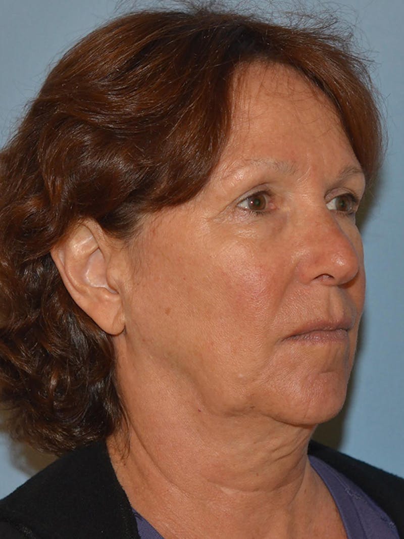 Lower Face & Neck Lift Before & After Gallery - Patient 277834 - Image 3