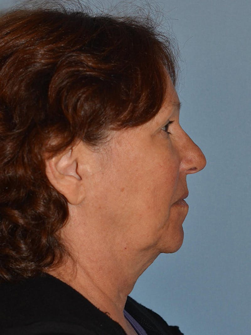 Lower Face & Neck Lift Before & After Gallery - Patient 277834 - Image 5