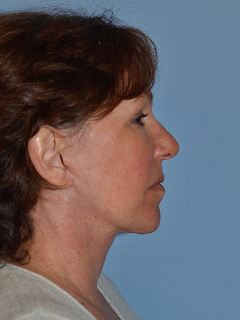Lower Face & Neck Lift Before & After Gallery - Patient 277834 - Image 6