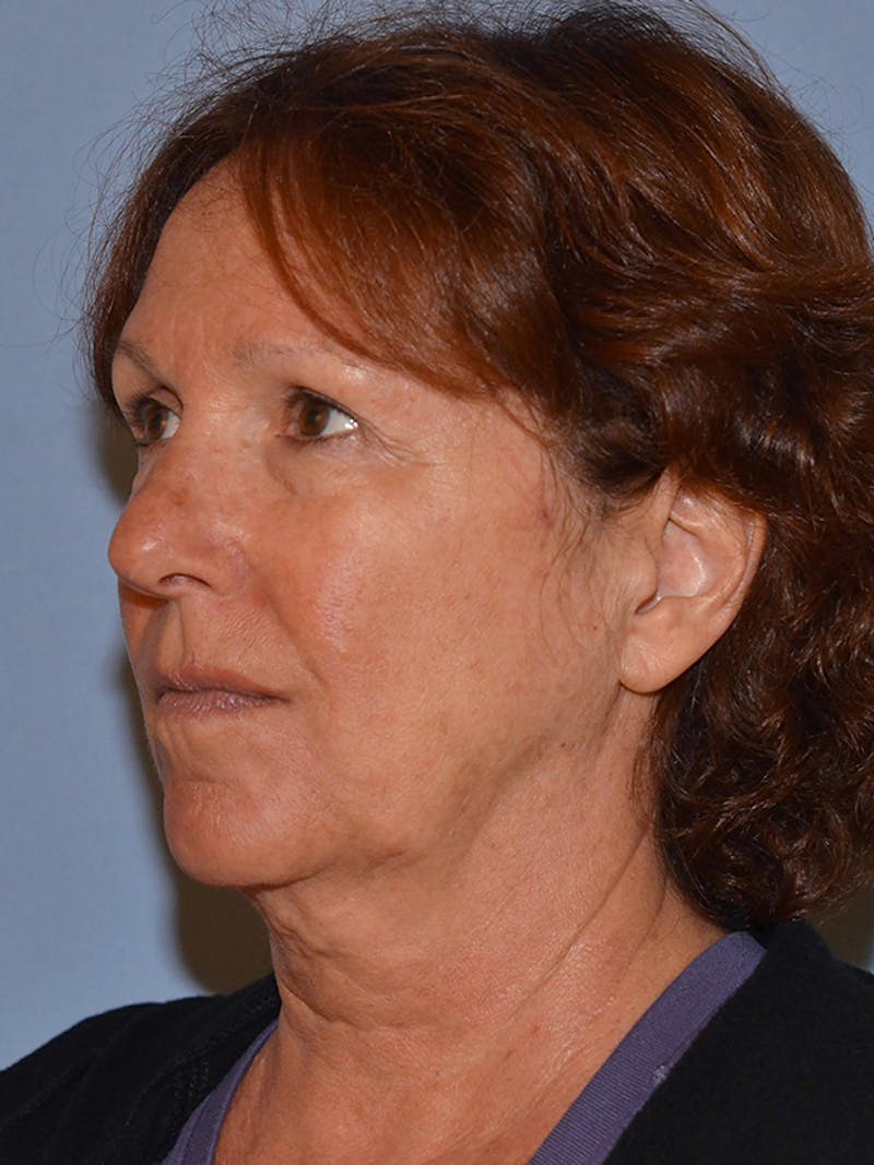 Lower Face & Neck Lift Before & After Gallery - Patient 277834 - Image 7