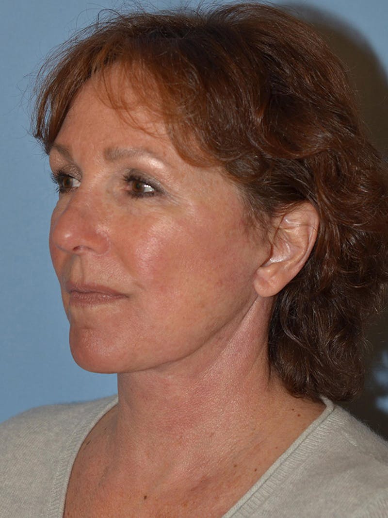 Lower Face & Neck Lift Before & After Gallery - Patient 277834 - Image 8