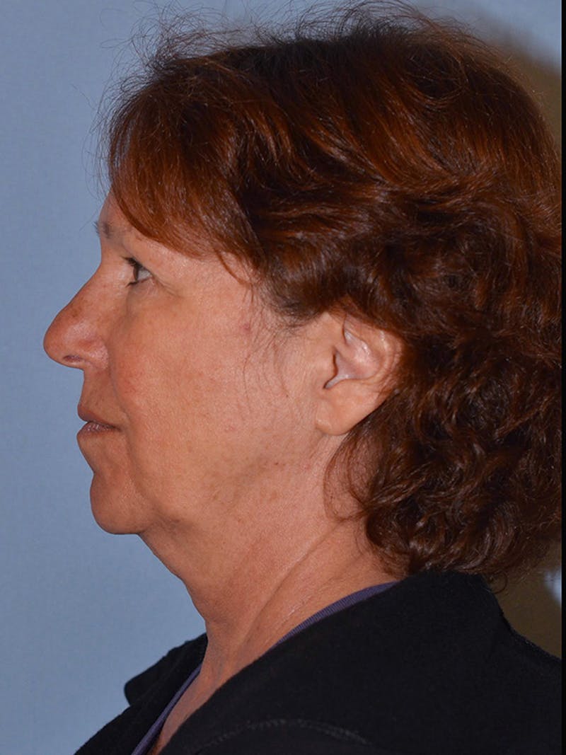 Lower Face & Neck Lift Before & After Gallery - Patient 277834 - Image 9