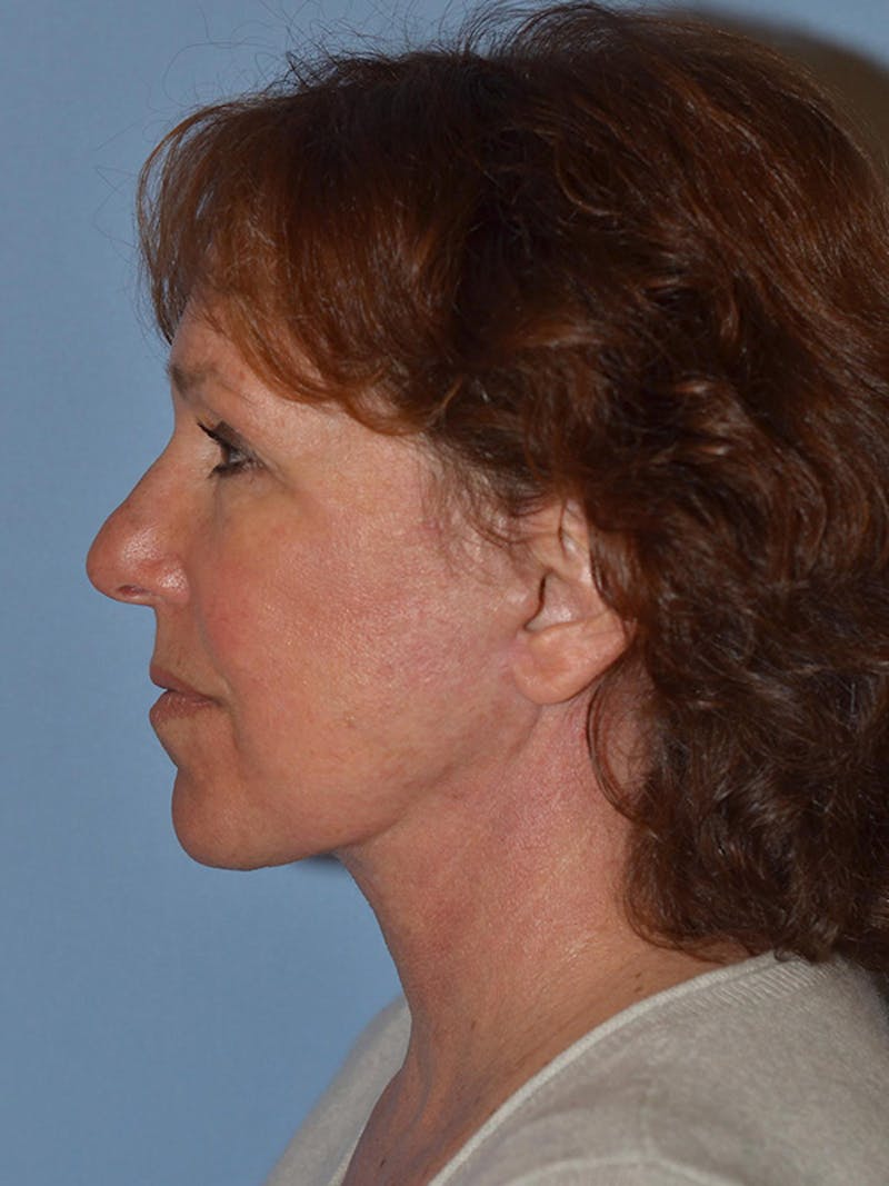 Lower Face & Neck Lift Before & After Gallery - Patient 277834 - Image 10