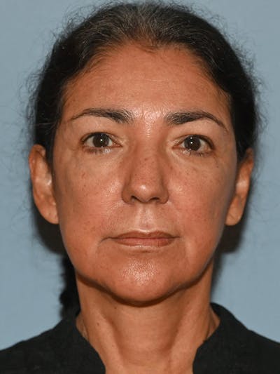 Lower Face & Neck Lift Before & After Gallery - Patient 140324 - Image 1