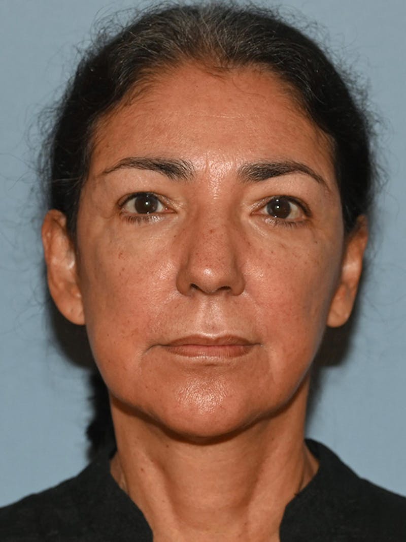 Lower Face & Neck Lift Before & After Gallery - Patient 140324 - Image 1