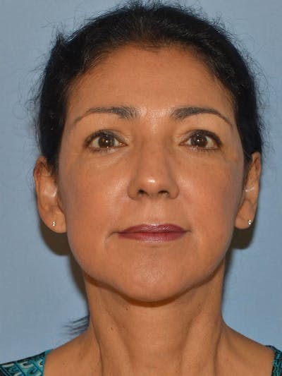Lower Face & Neck Lift Before & After Gallery - Patient 140324 - Image 2